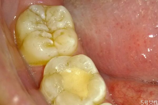 牙齦紅腫是為什么呢 造成牙齦紅腫的原因是什么呢 牙齦紅腫是為什么呢 造成牙齦紅腫的原因是什么呢