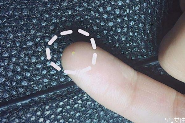 如何預防脂肪粒呢 預防脂肪粒的辦法有什么呢 如何預防脂肪粒呢 預防脂肪粒的辦法有什么呢