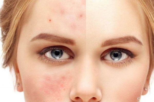 刷酸刷的是什么酸呢 護(hù)膚的酸有哪些呢 刷酸刷的是什么酸呢 護(hù)膚的酸有哪些呢