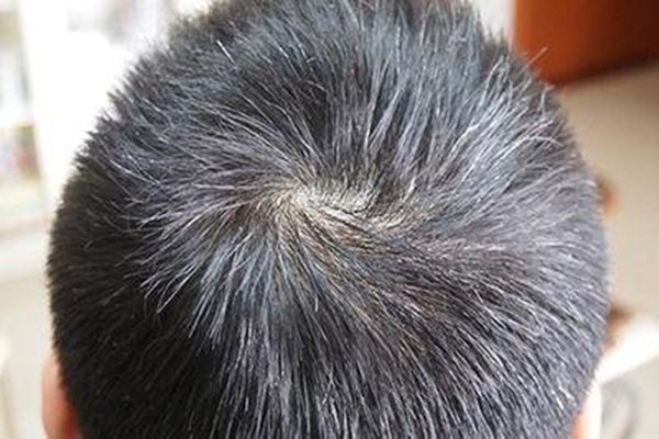 有白頭發(fā)拔了有害嗎 少年白吃什么可以調(diào)理 有白頭發(fā)拔了有害嗎 少年白吃什么可以調(diào)理