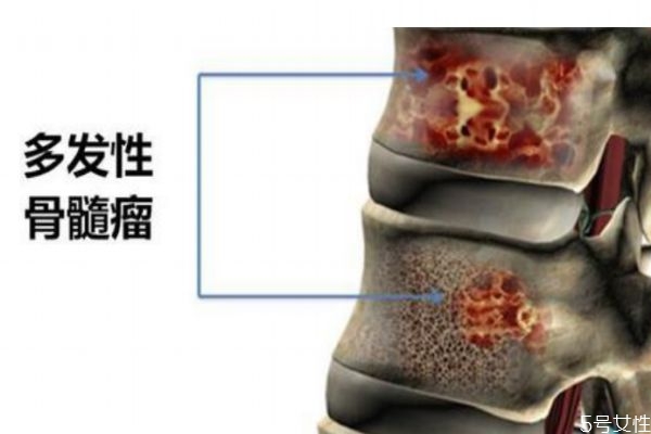 骨髓瘤造成的原因有什么呢 為什么會得骨髓瘤呢 骨髓瘤造成的原因有什么呢 為什么會得骨髓瘤呢