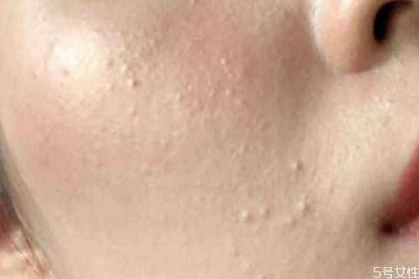 額頭長閉口怎么去除 額頭長閉口的原因