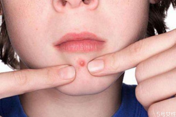 下巴為什么經(jīng)常長閉口呢 下巴長閉口的原因有什么呢 下巴為什么經(jīng)常長閉口呢 下巴長閉口的原因有什么呢
