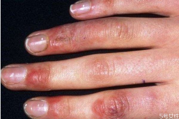 凍瘡是怎么造成的呢 為什么會有凍瘡呢 凍瘡是怎么造成的呢 為什么會有凍瘡呢