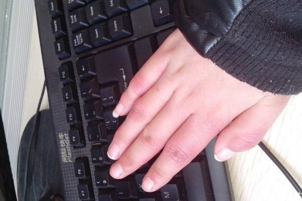 如何預(yù)防凍瘡呢 預(yù)防凍瘡的方法有什么呢 如何預(yù)防凍瘡呢 預(yù)防凍瘡的方法有什么呢