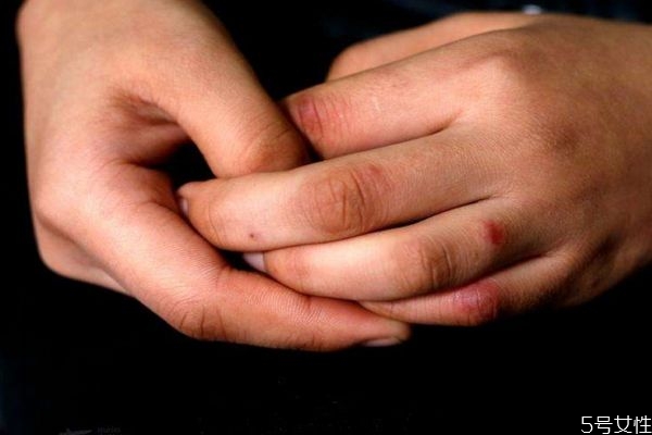 如何預(yù)防凍瘡呢 預(yù)防凍瘡的方法有什么呢 如何預(yù)防凍瘡呢 預(yù)防凍瘡的方法有什么呢