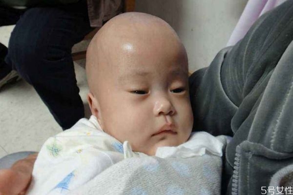 造成腦積水的原因有什么呢 為什么會得腦積水呢