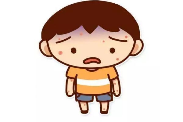 天花是一種什么疾病呢 得天花的癥狀有什么呢 天花是一種什么疾病呢 得天花的癥狀有什么呢