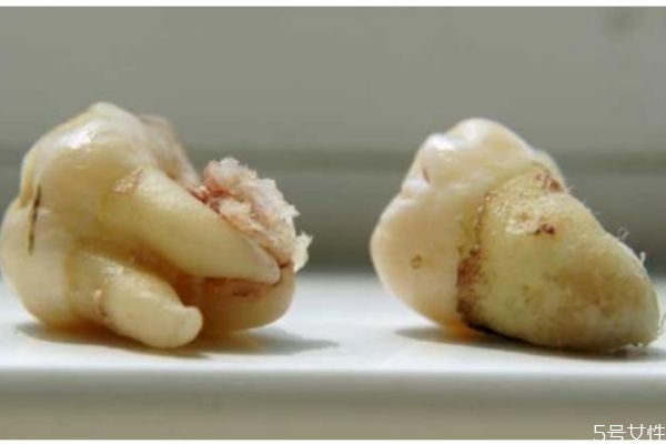 什么是智齒呢 每個(gè)人都會長智齒嗎 什么是智齒呢 每個(gè)人都會長智齒嗎