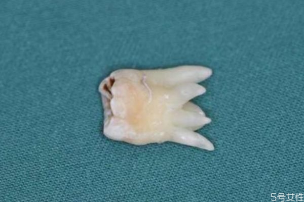 什么是智齒呢 每個(gè)人都會長智齒嗎 什么是智齒呢 每個(gè)人都會長智齒嗎