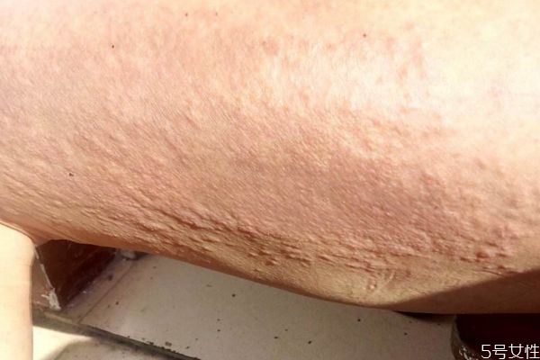 痱子是怎么造成的呢 為什么會(huì)有痱子呢 痱子是怎么造成的呢 為什么會(huì)有痱子呢