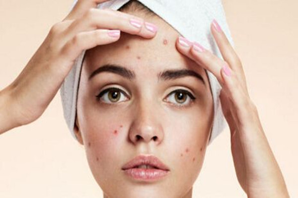 痘印消失的時間跟膚色有關(guān)嗎 痘印要多久能消除