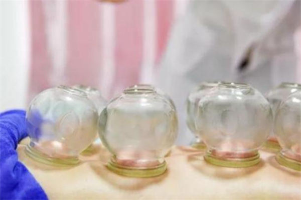 拔罐減肥多久有效果 拔罐減肥疼嗎 拔罐減肥多久有效果 拔罐減肥疼嗎