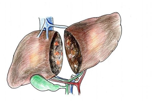 什么是肝硬化呢 肝硬化有什么危害呢 什么是肝硬化呢 肝硬化有什么危害呢