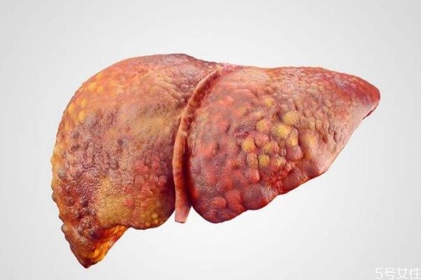 肝硬化造成的原因有什么呢 為什么會得肝硬化呢 肝硬化造成的原因有什么呢 為什么會得肝硬化呢