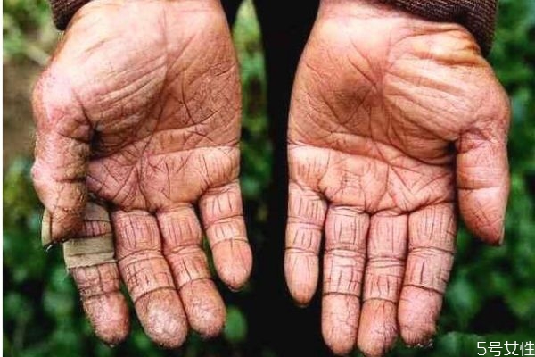 冬天為什么手會裂開 造成冬天手裂開的原因有什么 冬天為什么手會裂開 造成冬天手裂開的原因有什么