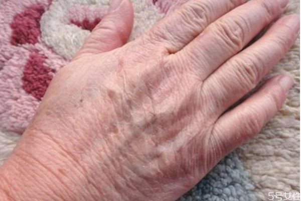 冬天為什么手會裂開 造成冬天手裂開的原因有什么 冬天為什么手會裂開 造成冬天手裂開的原因有什么