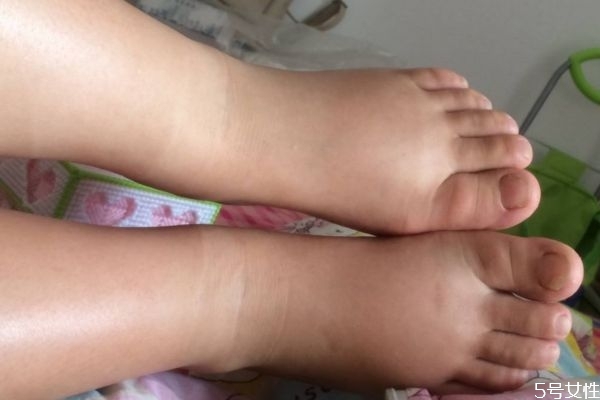 什么是水腫腿 水腫腿怎么瘦 什么是水腫腿 水腫腿怎么瘦