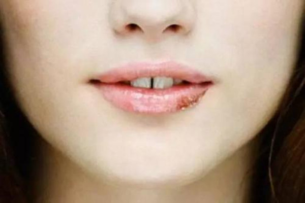 嘴角起泡可以弄破嗎 嘴角起泡要注意什么 嘴角起泡可以弄破嗎 嘴角起泡要注意什么