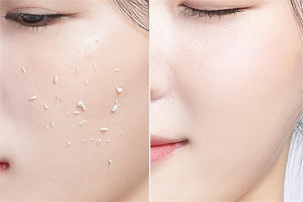 美康粉黛去角質啫喱怎么使用-可以去雞皮嗎