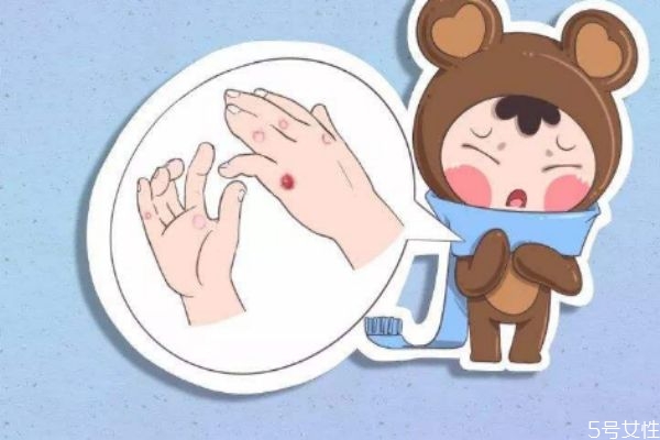 什么是凍瘡呢 你知道一個(gè)凍瘡有多大危害么 什么是凍瘡呢 你知道一個(gè)凍瘡有多大危害么