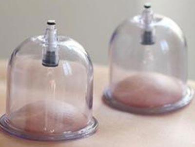 拔罐減肥需要每天拔嗎 拔罐減肥拔哪些部位 拔罐減肥需要每天拔嗎 拔罐減肥拔哪些部位