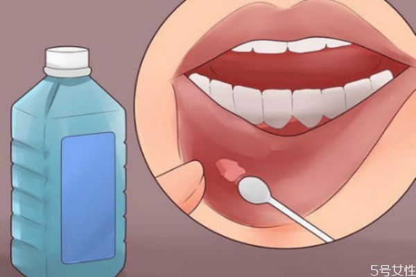 口腔潰瘍多長時間自愈 口腔潰瘍吃什么水果 口腔潰瘍多長時間自愈 口腔潰瘍吃什么水果