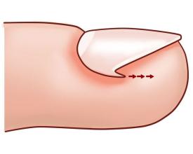 如何預(yù)防嵌甲呢 嵌甲能根治嗎 如何預(yù)防嵌甲呢 嵌甲能根治嗎