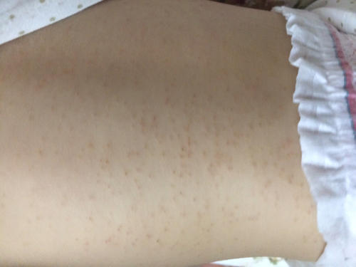 濕疹飲食要注意什么 濕疹不能吃什么 濕疹飲食要注意什么 濕疹不能吃什么