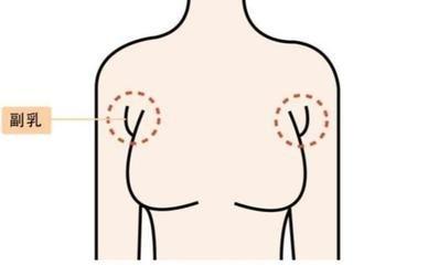 什么是副乳 怎么判斷自己有沒有副乳 什么是副乳 怎么判斷自己有沒有副乳