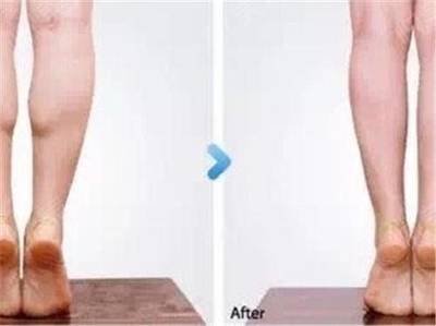 大象腿怎么形成的 大象腿會(huì)遺傳嗎 大象腿怎么形成的 大象腿會(huì)遺傳嗎