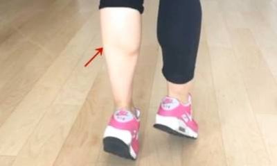 大象腿怎么形成的 大象腿會(huì)遺傳嗎 大象腿怎么形成的 大象腿會(huì)遺傳嗎