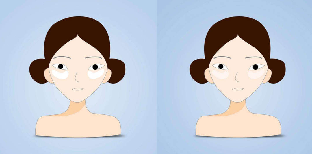 眼瞼水腫的原因 眼瞼水腫怎么辦 眼瞼水腫的原因 眼瞼水腫怎么辦