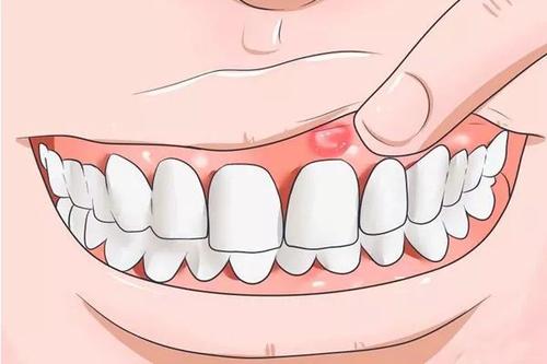 口腔潰瘍能吃無花果嗎 口腔潰瘍?yōu)槭裁捶磸?fù)發(fā)作