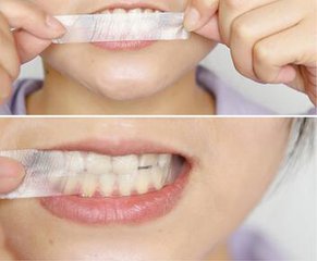 牙齒美白貼片是什么 牙齒美白貼片有幾種類型 牙齒美白貼片是什么 牙齒美白貼片有幾種類型