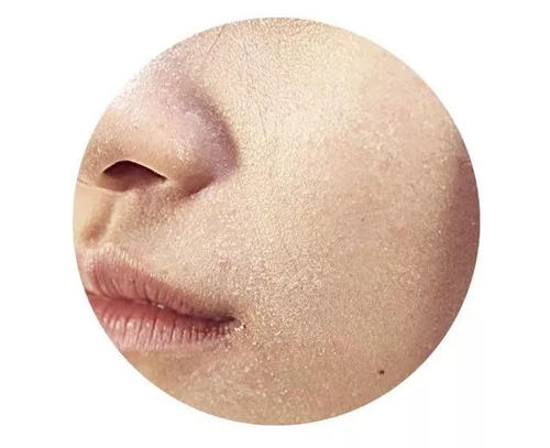 臉上化妝的地方起皮怎么辦 皮膚起皮怎么護(hù)理 臉上化妝的地方起皮怎么辦 皮膚起皮怎么護(hù)理