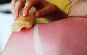 嚴重曬脫皮怎么護理 曬脫皮一周能好嗎 嚴重曬脫皮怎么護理 曬脫皮一周能好嗎