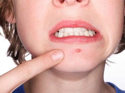 臉上長痘痘是體內有毒素嗎 臉上長痘痘可以用酒精嗎 臉上長痘痘是體內有毒素嗎 臉上長痘痘可以用酒精嗎