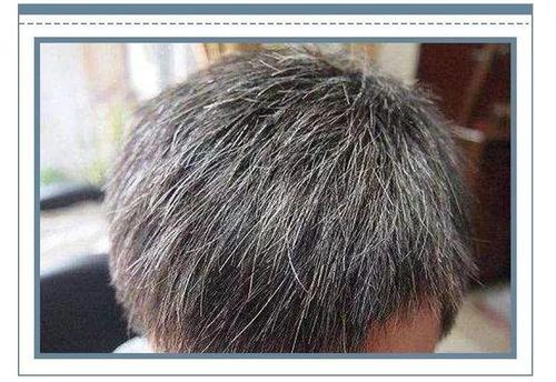 焦慮會長白頭發(fā)嗎 白頭發(fā)如何預(yù)防 焦慮會長白頭發(fā)嗎 白頭發(fā)如何預(yù)防