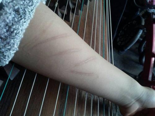 怎樣能防止傷口留疤 傷口留疤主要和什么有關(guān) 怎樣能防止傷口留疤 傷口留疤主要和什么有關(guān)