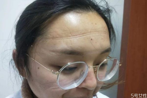 長時(shí)間戴口罩對皮膚的影響 戴口罩應(yīng)該怎么護(hù)膚