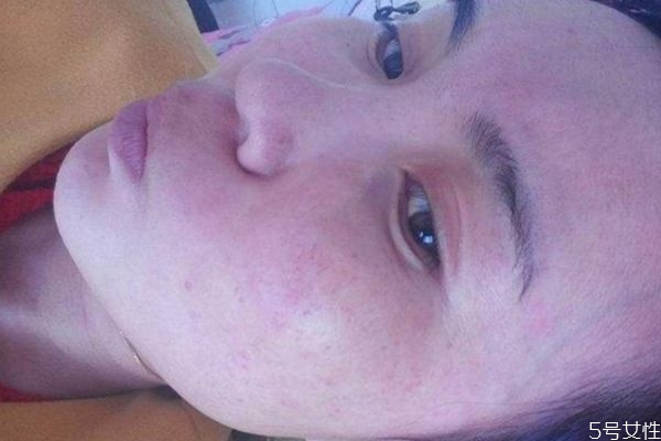 化妝品過(guò)敏可以自愈嗎 化妝品過(guò)敏如何治療