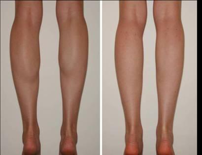 小腿腓腸肌怎么捏變瘦 拍打小腿腓腸肌能變瘦嗎 小腿腓腸肌怎么捏變瘦 拍打小腿腓腸肌能變瘦嗎