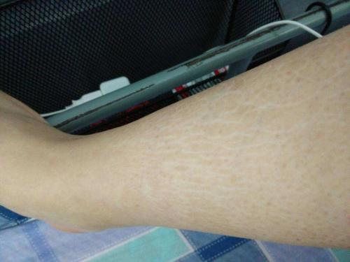 大腿上為什么會有肥胖紋呢 怎么緩解大腿上的肥胖紋呢 大腿上為什么會有肥胖紋呢 怎么緩解大腿上的肥胖紋呢