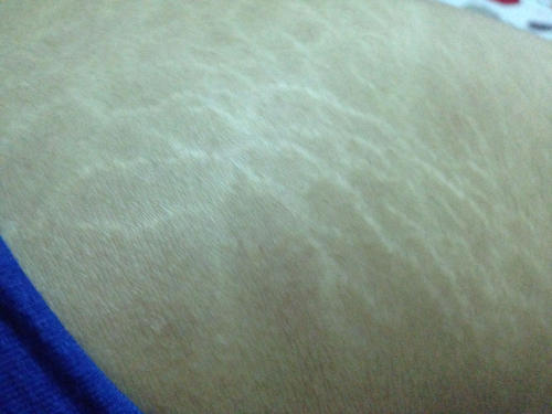 大腿上為什么會有肥胖紋呢 怎么緩解大腿上的肥胖紋呢 大腿上為什么會有肥胖紋呢 怎么緩解大腿上的肥胖紋呢