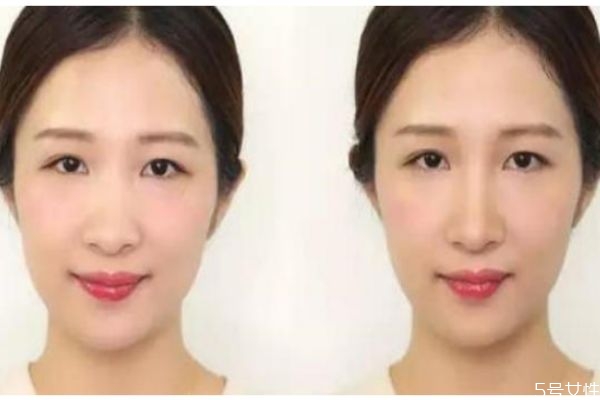 如何收縮鼻翼 收縮鼻翼的辦法 如何收縮鼻翼 收縮鼻翼的辦法