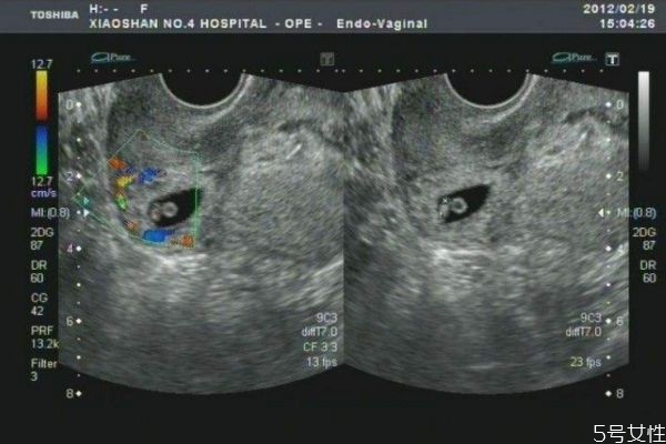 什么是瘢痕子宮 瘢痕子宮可以懷孕嗎 什么是瘢痕子宮 瘢痕子宮可以懷孕嗎