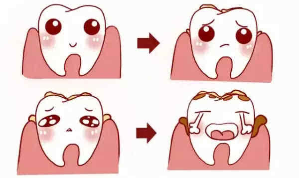 頻繁洗牙對牙齒的壞處 電動牙刷的壞處 頻繁洗牙對牙齒的壞處 電動牙刷的壞處