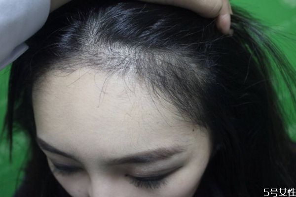 修容棒可以修發(fā)際線嗎 如何修飾發(fā)際線 修容棒可以修發(fā)際線嗎 如何修飾發(fā)際線