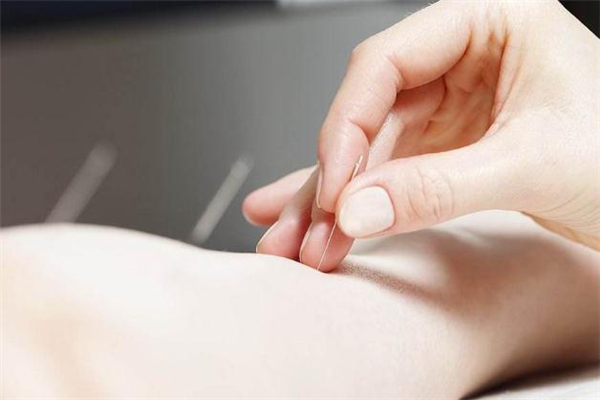 經(jīng)期可以針灸減肥嗎 針灸減肥會導(dǎo)致月經(jīng)推遲嗎 經(jīng)期可以針灸減肥嗎 針灸減肥會導(dǎo)致月經(jīng)推遲嗎